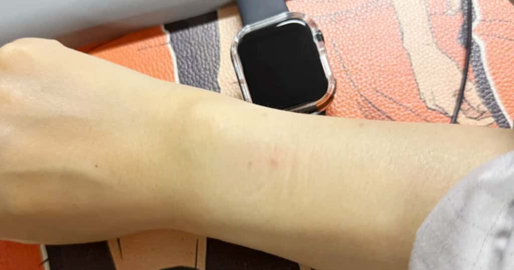 Apple Watchを着けた手首に見える赤み